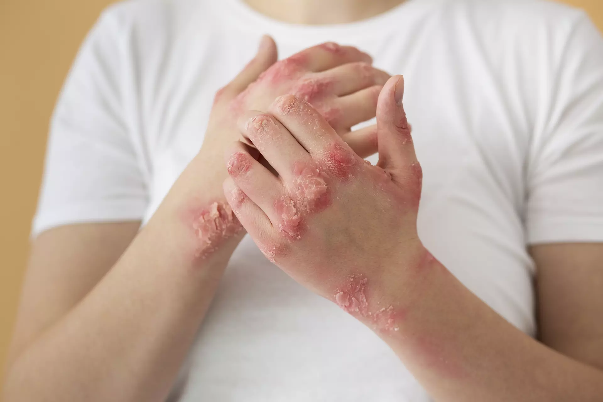 Eczema treatment in Tucson, AZ