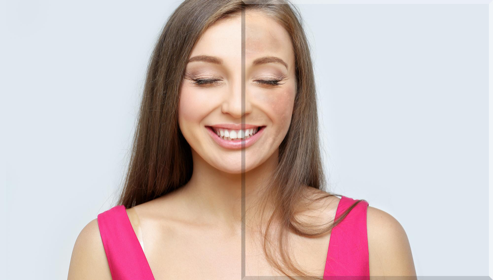 Melasma treatment in Tucson, AZ