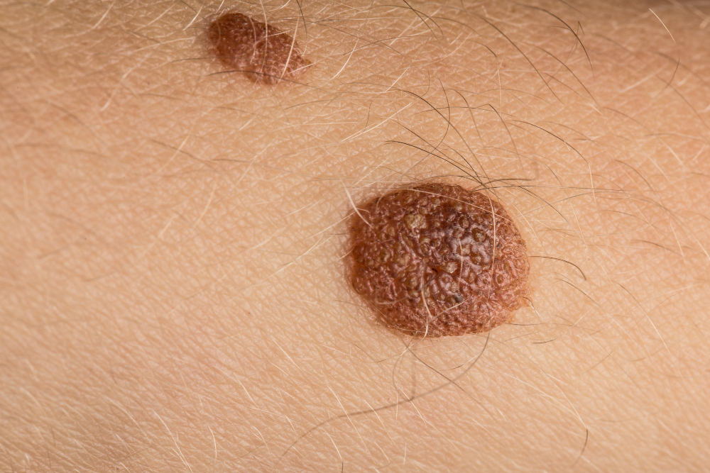 Seborrheic keratosis removal in Tucson, AZ
