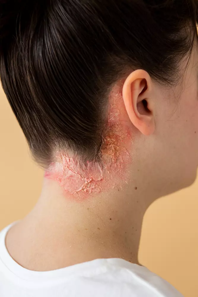 Psoriasis treatment in Tucson, AZ